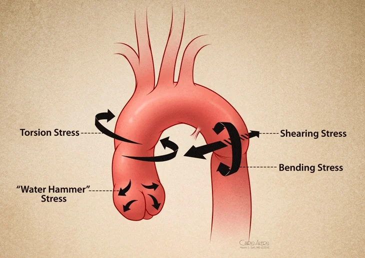 Diagram of the aortic arch annotated with torsion, shearing, bending, and water hammer stress during deceleration.