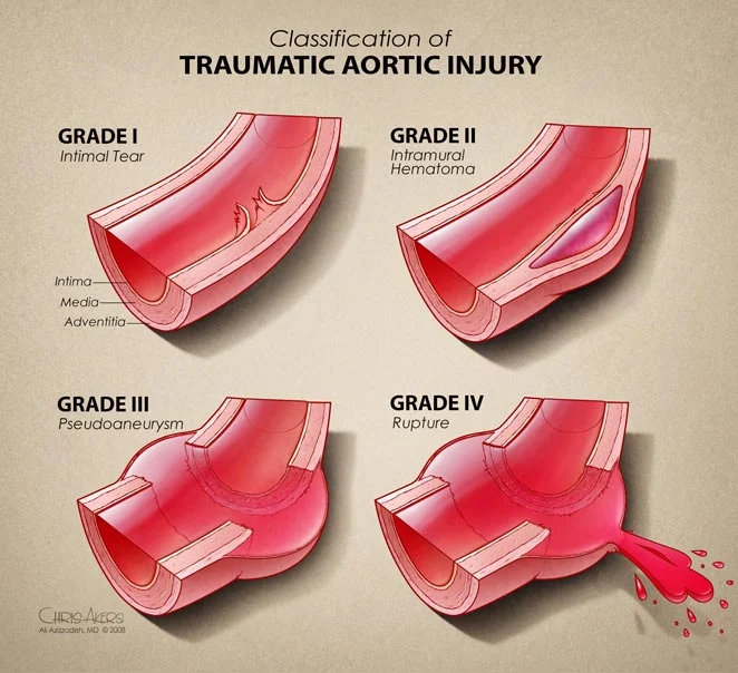 Classification of traumatic aortic injury: Grade I intimal tear, Grade II intramural hematoma, Grade III pseudoaneurysm, Grade IV rupture, in cross-section.