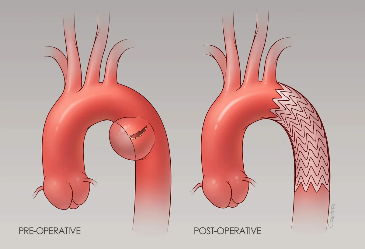 Illustration of the aortic arch before and after TEVAR: a tear pre-operatively, and a stent graft bridging the injury post-operatively.